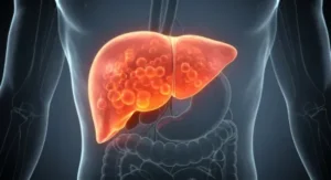 fatty liver